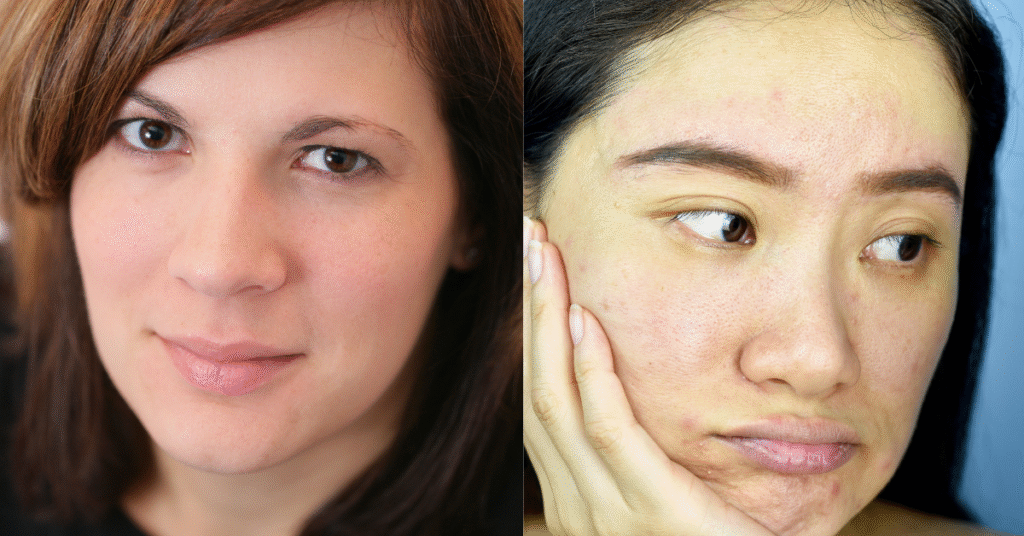 Before and after glowing skin results in the 30s